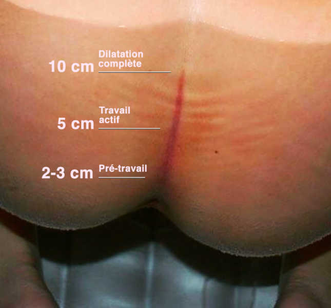 Cette précieuse ligne pourpre pendant l'accouchement peut indiquer votre dilatation (sans toucher vaginal !)