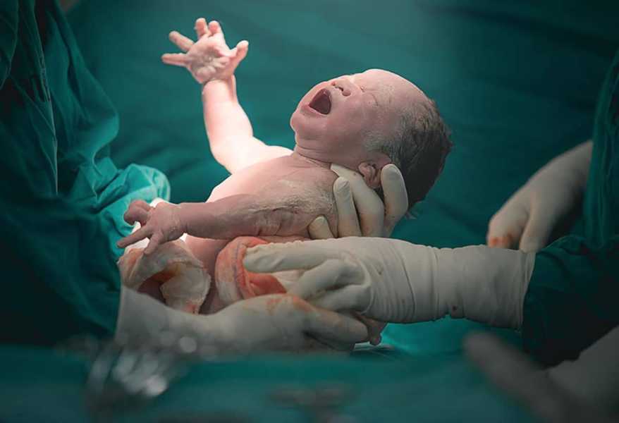 bébé né par césarienne