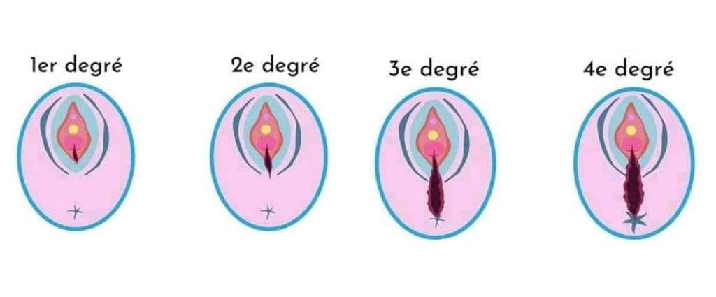 Les 4 différents degrés de déchirures pendant l'accouchement