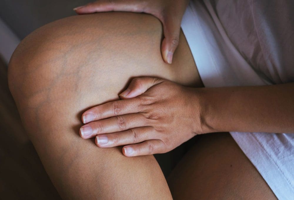 les meilleurs remèdes naturels en cas de varice vulvaire pendant la grossesse sur Naturelle maman