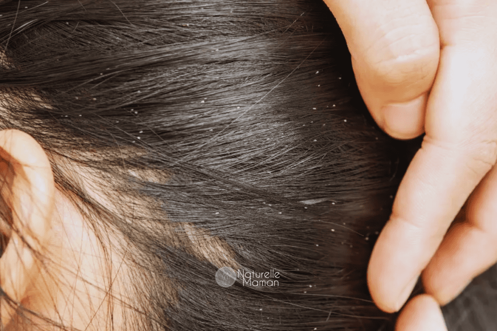 Remèdes naturels anti-poux : mes 5 solutions naturelles les plus efficaces pour en venir à bout