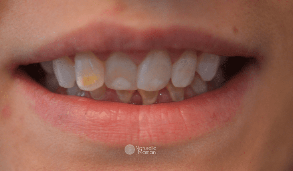 Faut-il choisir un dentifrice avec ou sans fluor pour vos enfants ?